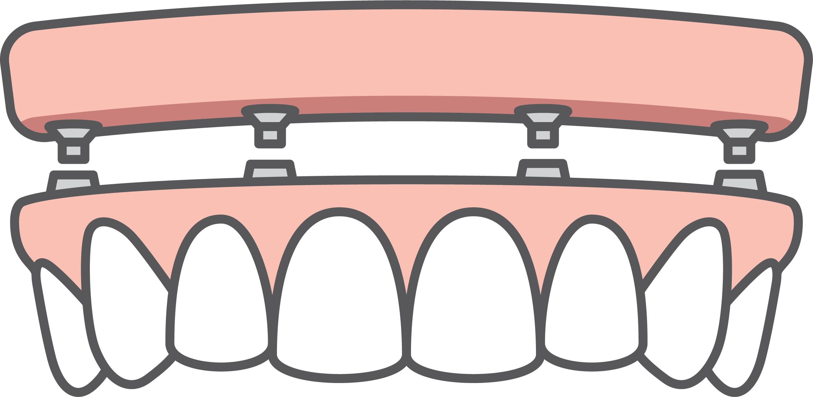 Fig 3. A complete set of dentures is held in place by dental implants.