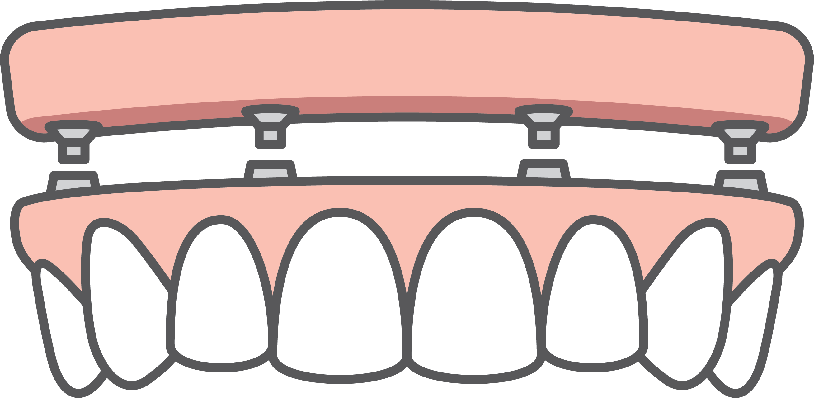 Fig 3. A complete set of dentures is held in place by dental implants. Fig 3. A complete set of dentures is held in place by dental implants.