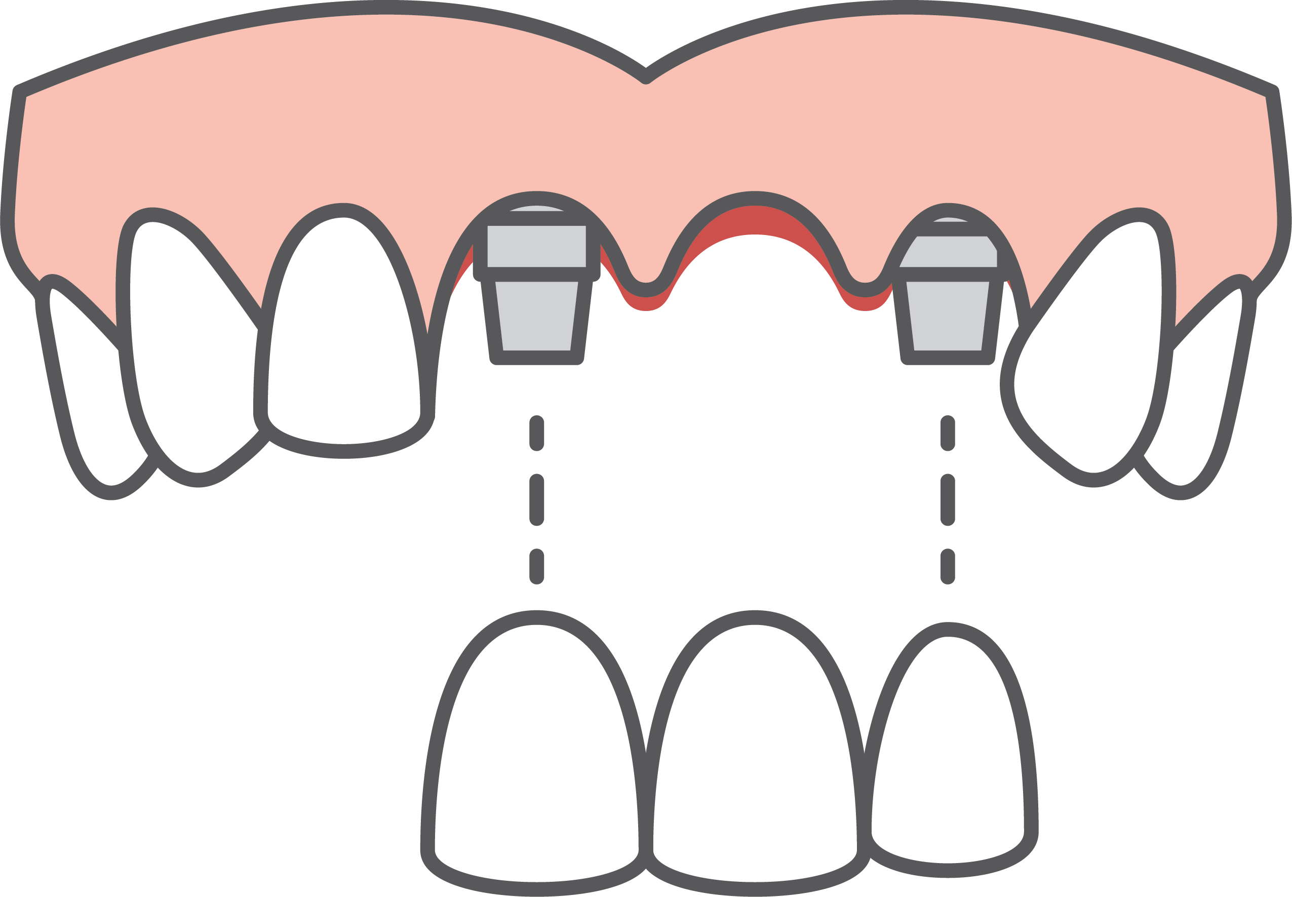 Fig 2. A bridge, supported by dental implants, replaces multiple teeth.
