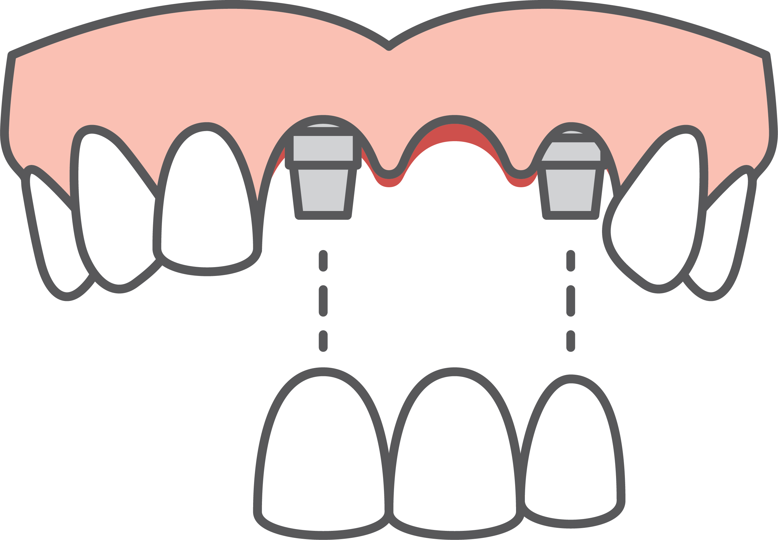 Fig 2. A bridge, supported by dental implants, replaces multiple teeth. Fig 2. A bridge, supported by dental implants, replaces multiple teeth.