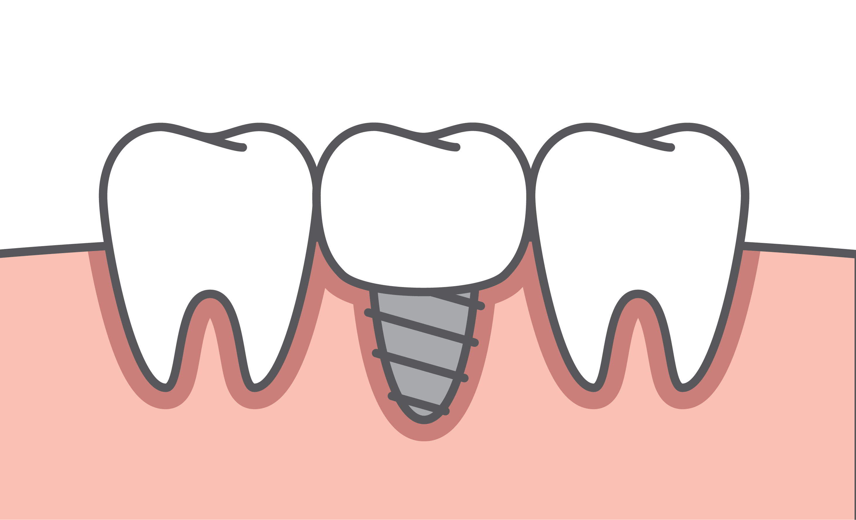 Fig 1. A single tooth is replaced with a crown supported upon a dental implant.