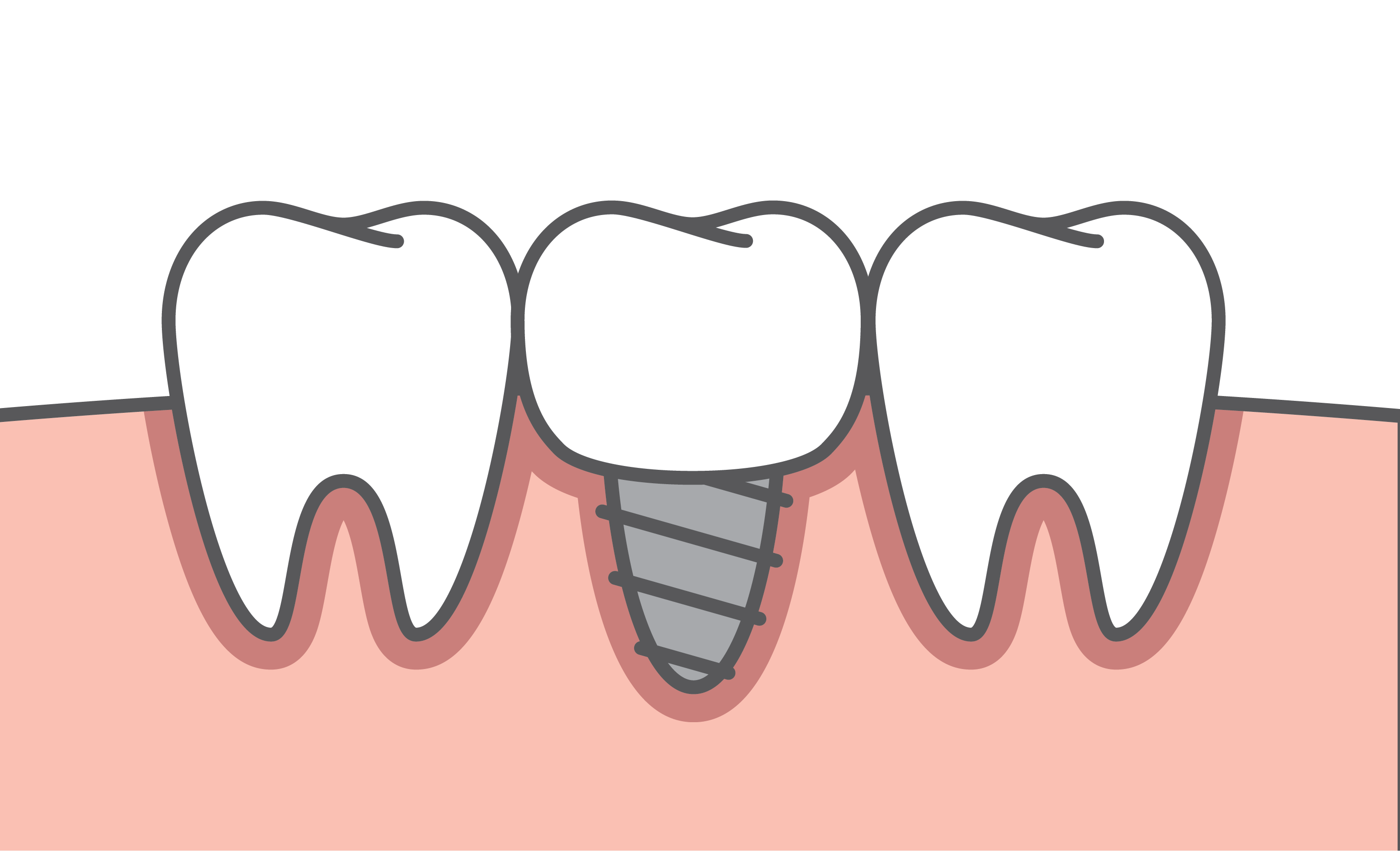 Fig 1. A single tooth is replaced with a crown supported upon a dental implant. Fig 1. A single tooth is replaced with a crown supported upon a dental implant.